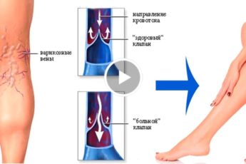 11 натуральных способов лечения варикоза!